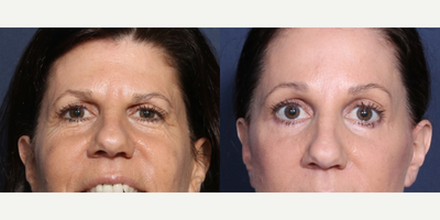 Eyelid Surgery before and after photo