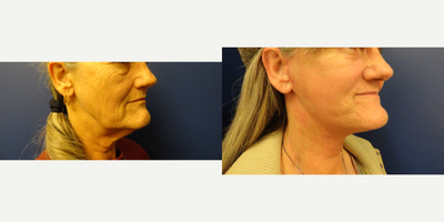 Facelift before and after photo