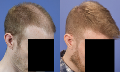 FUE Hair Transplant before and after photo