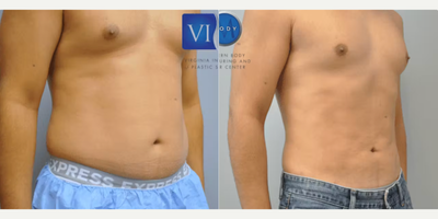 Liposuction before and after photo