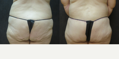 Tummy Tuck before and after photo