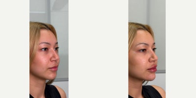 Chin Filler before and after photo