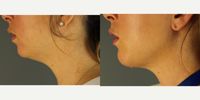 Chin Implant before and after photo
