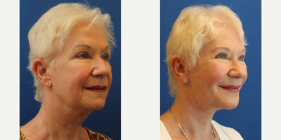 Facelift before and after photo