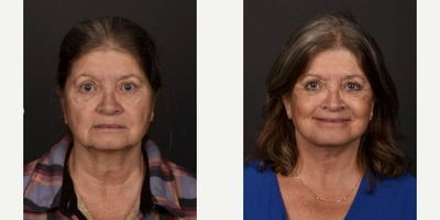 Facelift before and after photo