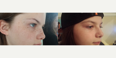 IPL before and after photo