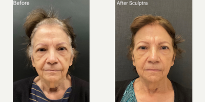 Sculptra before and after photo