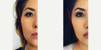 Dysport before and after photo