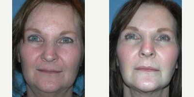 Chemical Peel before and after photo