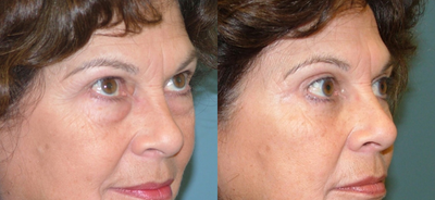 Eyelid Surgery before and after photo