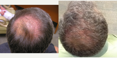 Hair Transplant before and after photo