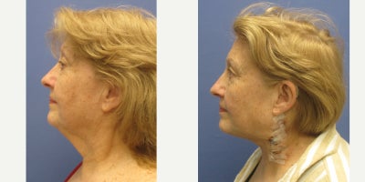 Neck Lift before and after photo