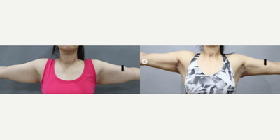 Arm Lift before and after photo