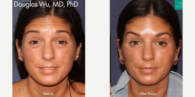 Botox before and after photo