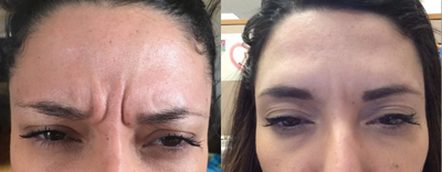 Botox before and after photo