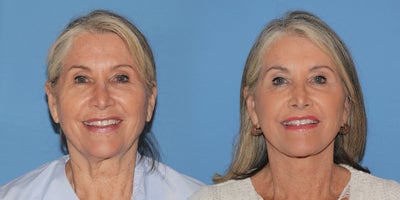 Deep Plane Facelift before and after photo