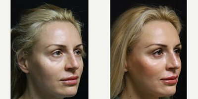 Eyelid Surgery before and after photo