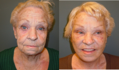 Facelift before and after photo