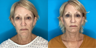 Neck Lift before and after photo