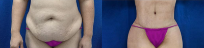 Tummy Tuck before and after photo