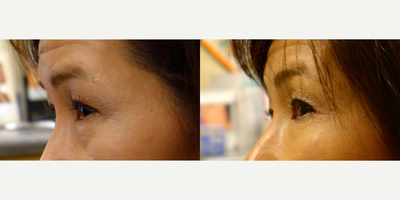 Voluma before and after photo