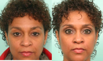Botox before and after photo