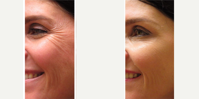 Botox before and after photo