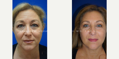 Eyelid Surgery before and after photo