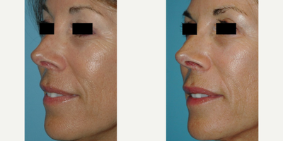 Microneedling before and after photo