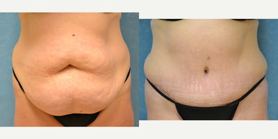 Tummy Tuck before and after photo