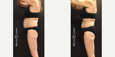 CoolSculpting before and after photo
