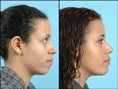 Chin Implant before and after photo