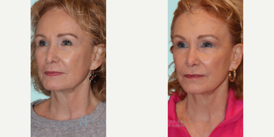 Dysport before and after photo