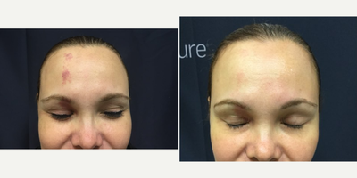 Excel V before and after photo