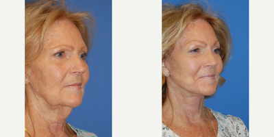 Facelift before and after photo