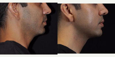 Sculptra before and after photo