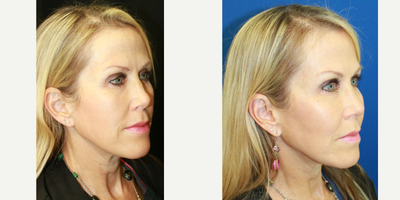 Cheek Augmentation before and after photo