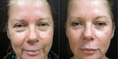 Laser Resurfacing before and after photo