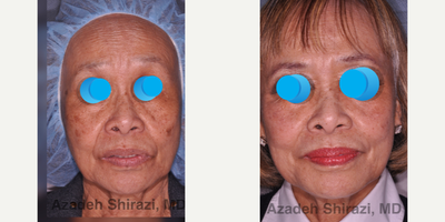 Liquid Facelift before and after photo
