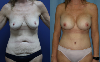 Mommy Makeover before and after photo