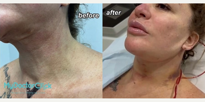 Neck Lift before and after photo
