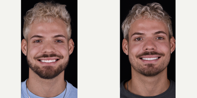 Porcelain Veneers before and after photo