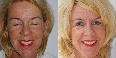 Rhinoplasty before and after photo