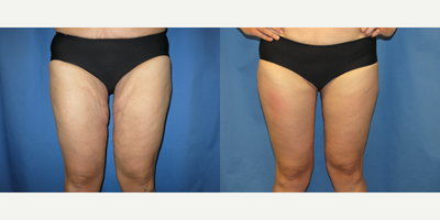 Thigh Lift before and after photo
