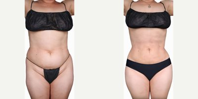 Tummy Tuck before and after photo