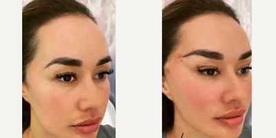Brow Lift before and after photo