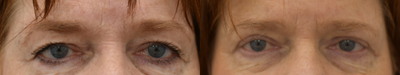 Eyelid Surgery before and after photo