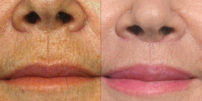 Lip Lift before and after photo