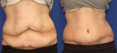 Tummy Tuck before and after photo