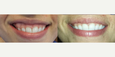 Botox for Gummy Smile before and after photo